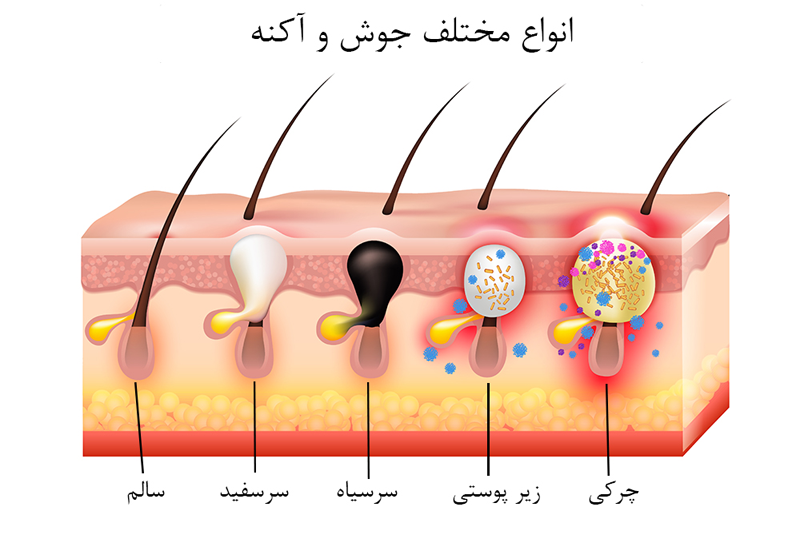 انواع جوش صورت